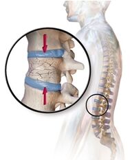 Osteoporoos kutsub esile seljavalu alaseljas